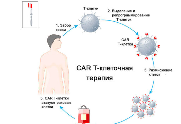 CAR-T-терапия-один из самых прогрессивных методов лечения рака